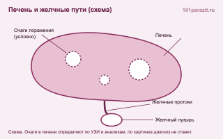 Печеночные сосальщики – как выявить в организме?