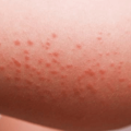 Симптомы наличия паразитов: сыпь на коже