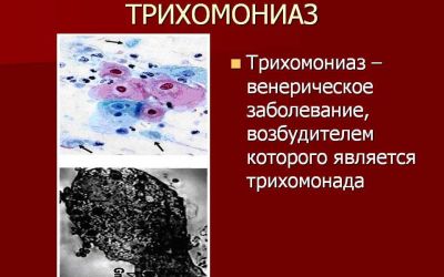Что нужно знать о трихомониазе