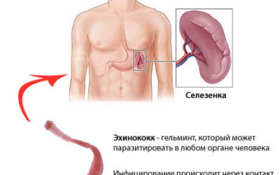 Что важно знать об эхинококкозе у человека