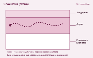 Что нужно знать о филяриозе у человека